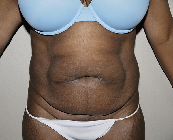 Before Image: Abdominoplasty - front