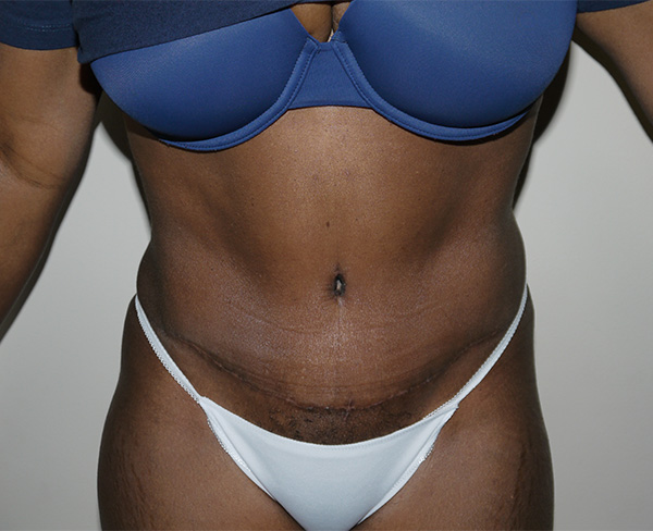 After Image: Abdominoplasty - front