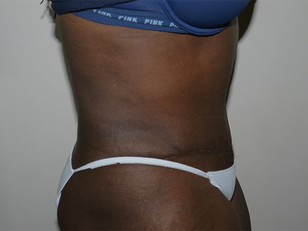 After Image: Abdominoplasty - right-side