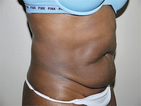 Before Image: Abdominoplasty - right-front-oblique