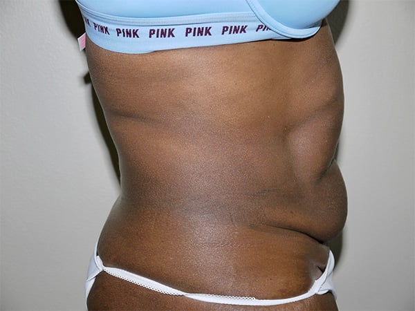 Before Image: Abdominoplasty - right-side