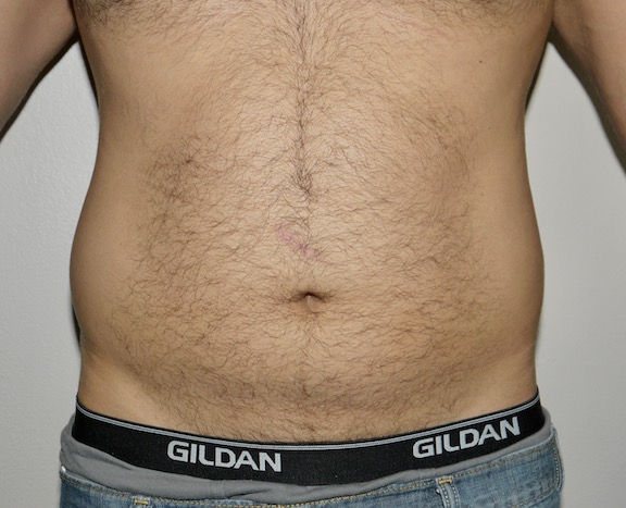 Before Image: Liposuction - front