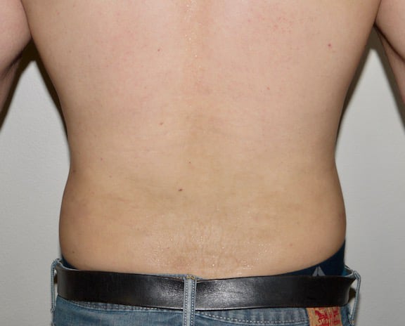 After Image: Liposuction - back