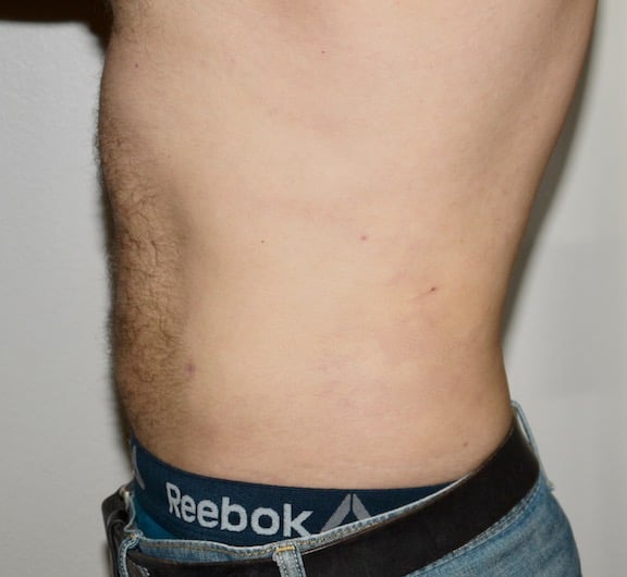 After Image: Liposuction - left-side