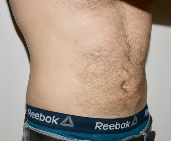 After Image: Liposuction - right-front-oblique