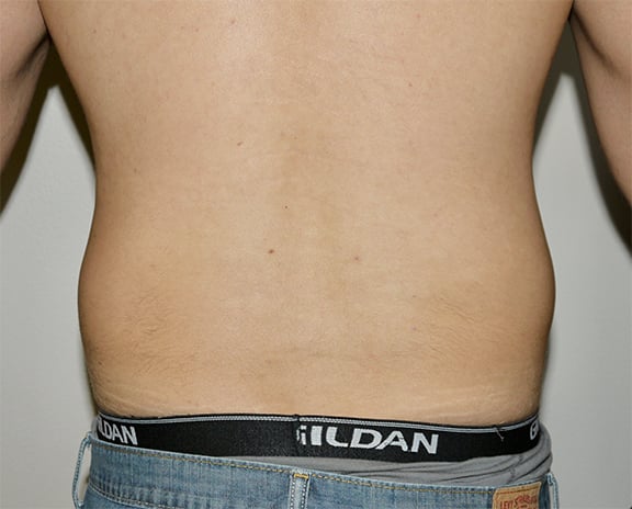 Before Image: Liposuction - back