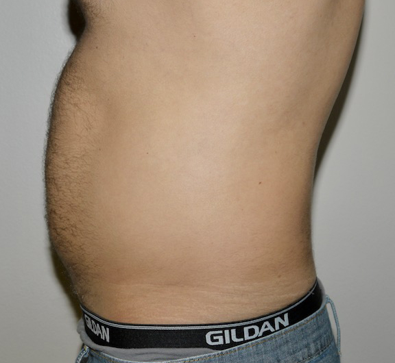 Before Image: Liposuction - left-side