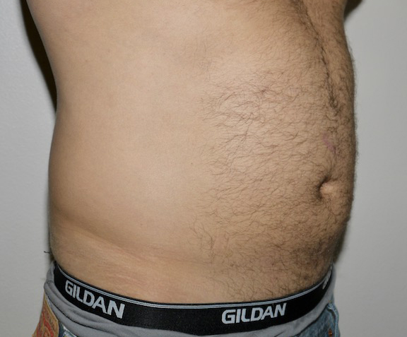 Before Image: Liposuction - right-front-oblique
