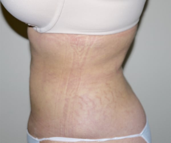 After Image: Liposuction - left-side