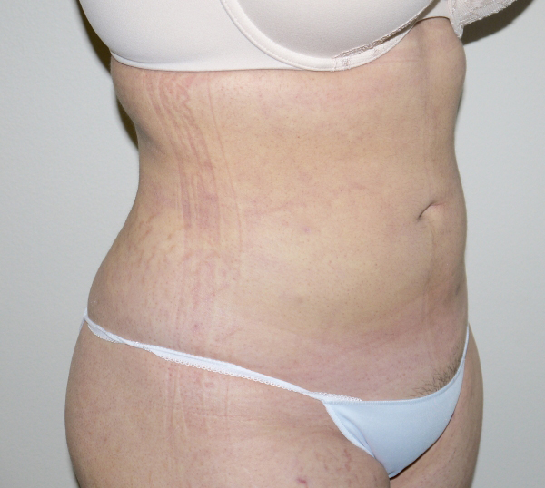 After Image: Liposuction - right-front-oblique