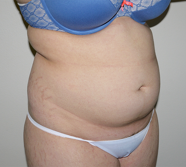 Before Image: Liposuction - right-front-oblique