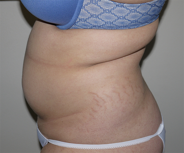 Before Image: Liposuction - left-side