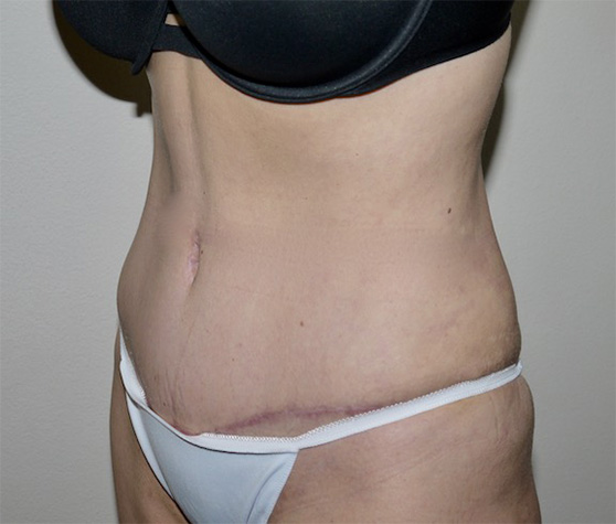After Image: Abdominoplasty - left-front-oblique