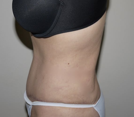 After Image: Abdominoplasty - left-side