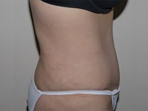 After Image: Abdominoplasty - right-side