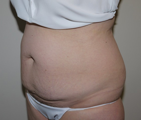 Before Image: Abdominoplasty - left-front-oblique