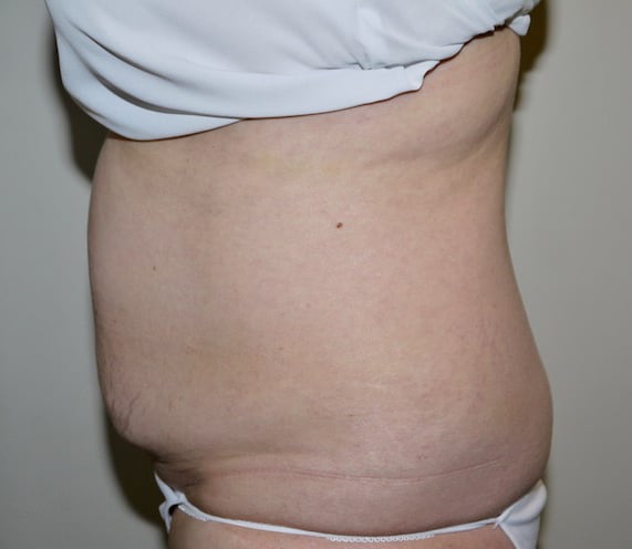Before Image: Abdominoplasty - left-side