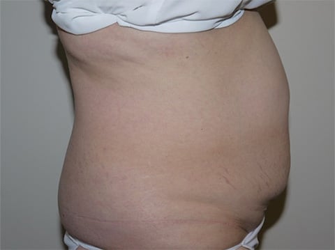Before Image: Abdominoplasty - right-side
