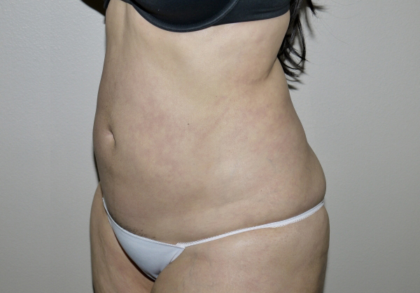 After Image: Liposuction - left-front-oblique