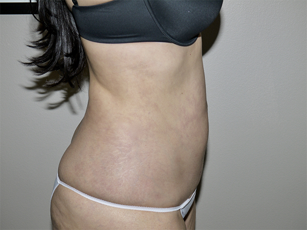After Image: Liposuction - right-side