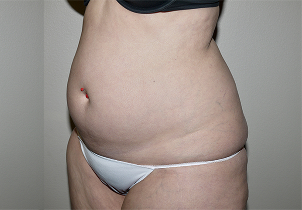 Before Image: Liposuction - left-front-oblique