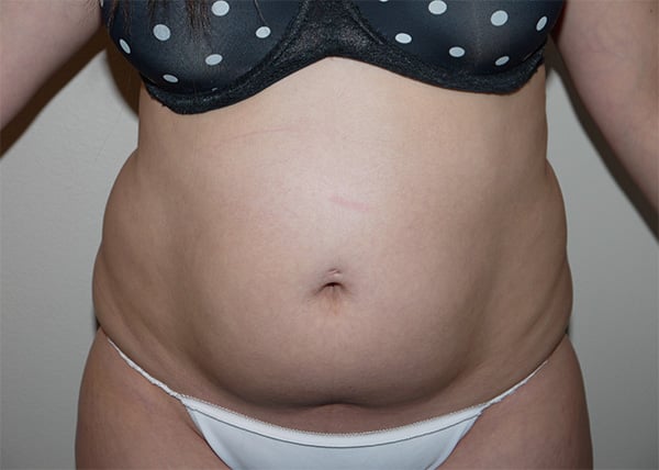 Before Image: Liposuction - front