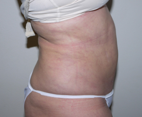 After Image: Liposuction - right-side