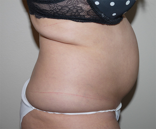 Before Image: Liposuction - right-side
