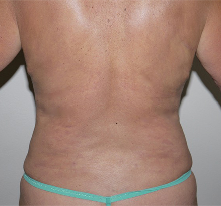 After Image: Liposuction - back