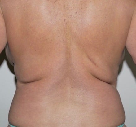 Before Image: Liposuction - back