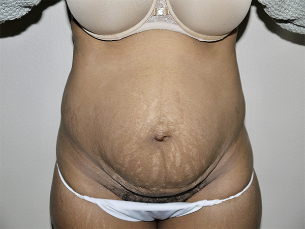 Before Image: Abdominoplasty - front