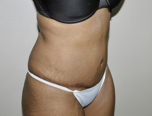 After Image: Abdominoplasty - right-front-oblique