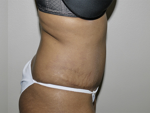 After Image: Abdominoplasty - right-side