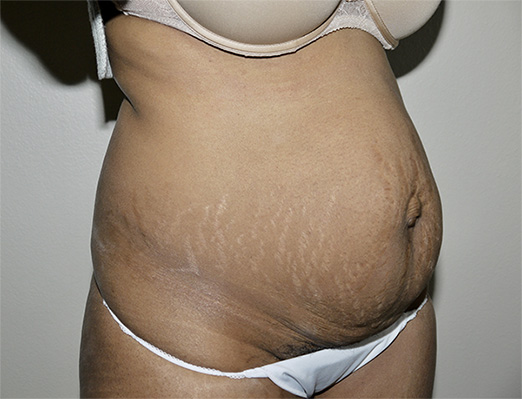 Before Image: Abdominoplasty - right-front-oblique