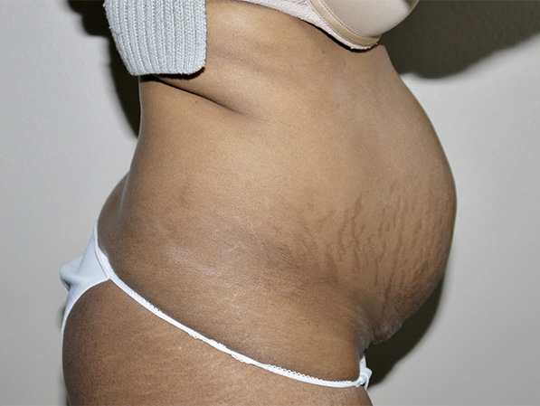 Before Image: Abdominoplasty - right-side
