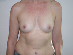 Before Image: Breast Augmentation - front