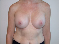 After Image: Breast Augmentation - front