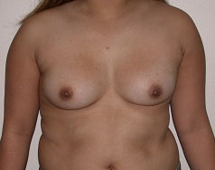 Before Image: Breast Augmentation - front