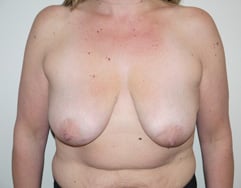 Before Image: Breast Lift with Augmentation - front