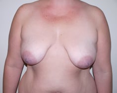 Before Image: Breast Lift - front