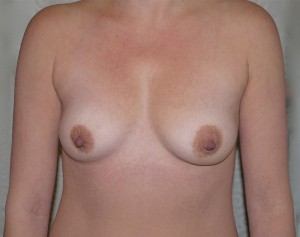 Before Image: Breast Augmentation - front