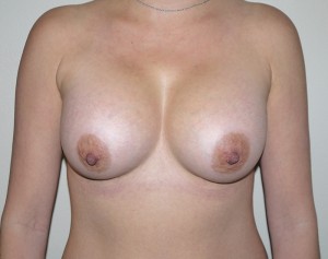 After Image: Breast Augmentation - front