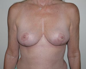 After Image: Breast Implant Revision - front