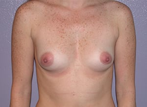 Before Image: Breast Augmentation - front