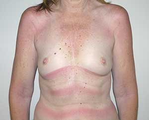 Before Image: Breast Augmentation - front