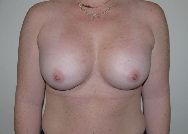 After Image: Breast Augmentation - front