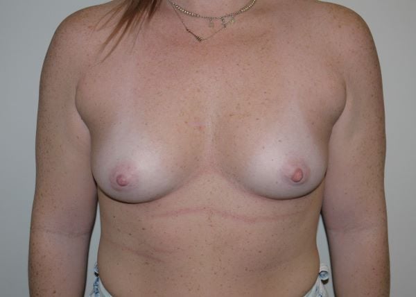 Before Image: Breast Augmentation - front