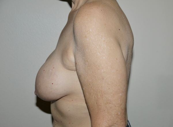 Before Image: Breast Implant Removal with Lift - left-side