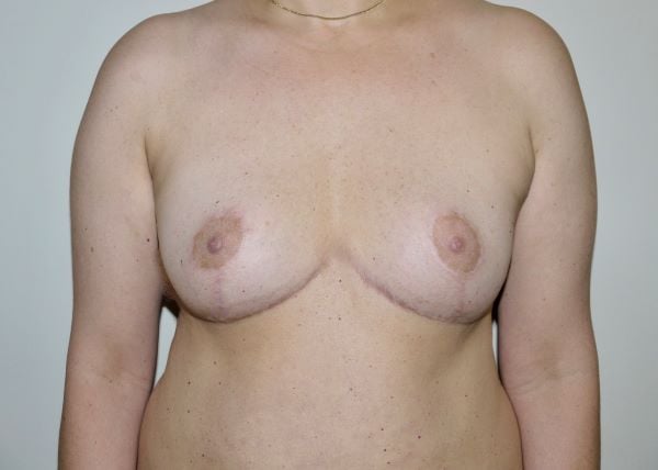 After Image: Breast Implant Removal with Lift - front