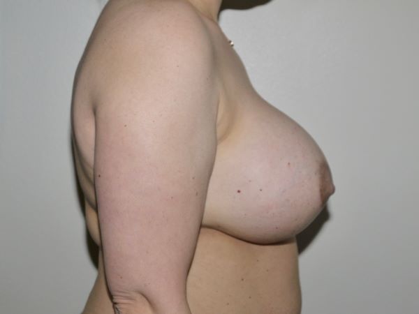 Before Image: Breast Implant Removal with Lift - right-side